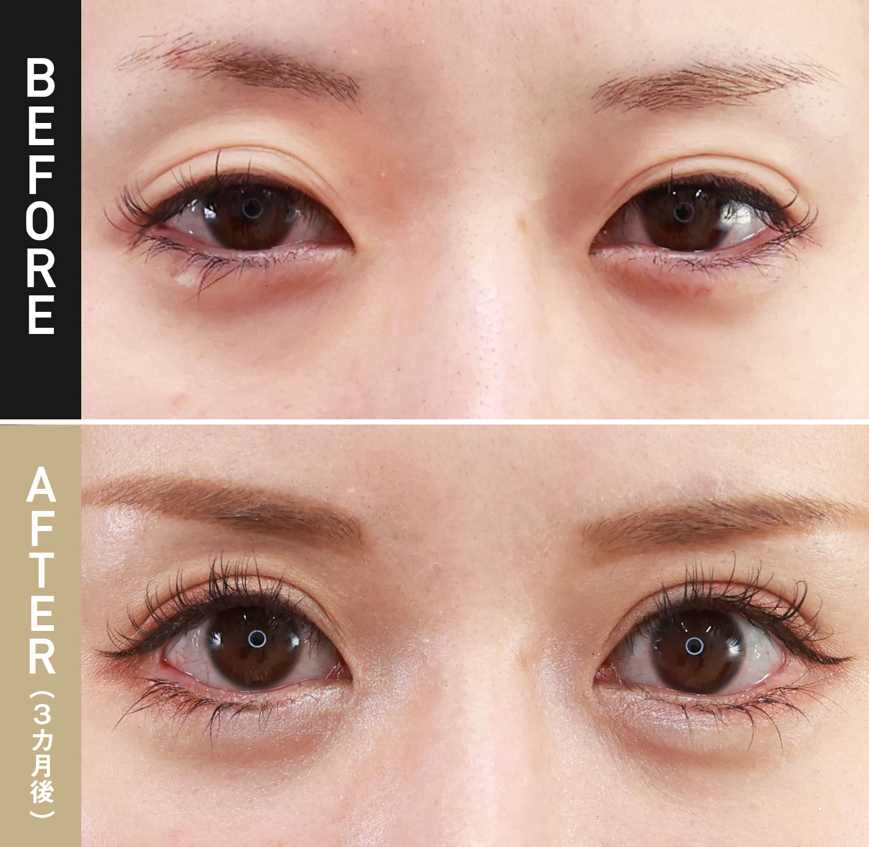 埋没眼瞼下垂（目つき矯正） |症例写真（術後3ヵ月）|20代女性