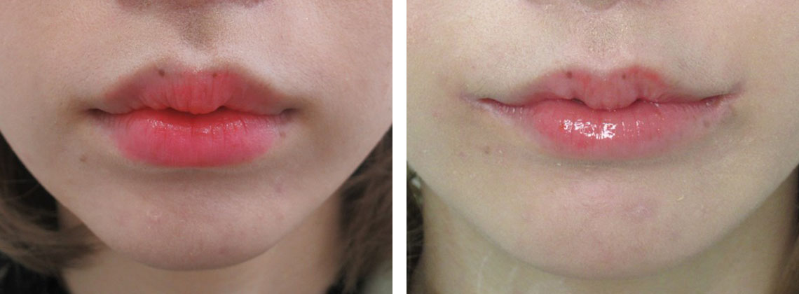 ボトックス ボツリヌストキシン注射 エラ 口角 ふくらはぎ 肩 目の下 脇汗に 効果と料金 福岡市天神駅前の美容整形外科 福岡taクリニック