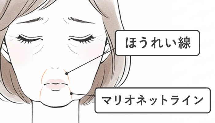 ほうれい線・マリオネットラインのイラスト